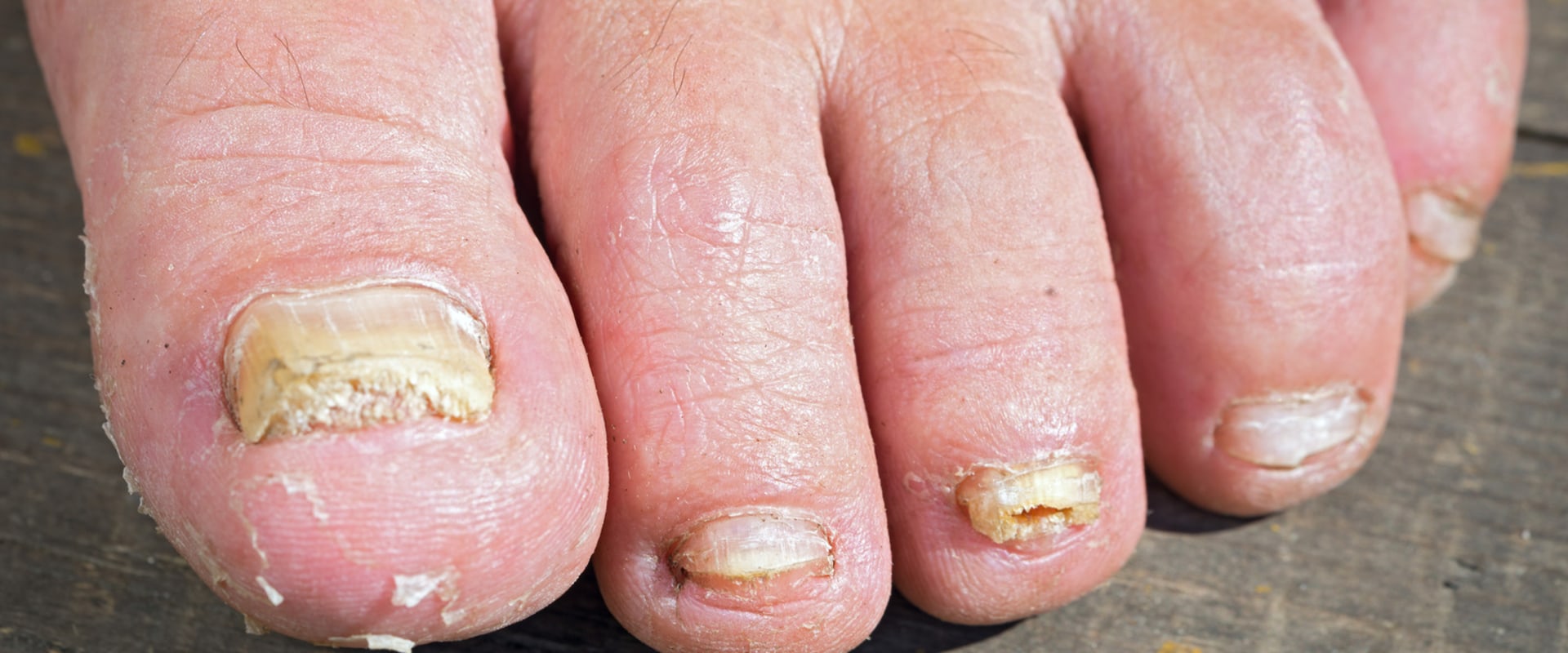 swimming-with-toenail-fungus-is-it-safe-revised