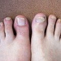 What is the fastest way to cure toenail fungus?