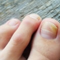 Is Toenail Fungus Treatment Working? Here's How to Know