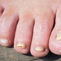 What are the most common treatments for toenail fungus?