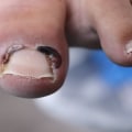 What happens if you have toenail fungus for years?