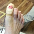 How to Get Rid of Toenail Fungus Permanently