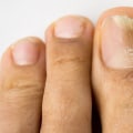 The Connection Between Toenail Fungus and Gut Health