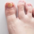 Can Toenail Fungus Go Away on Its Own? - An Expert's Perspective