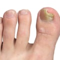 What kills toenail fungus permanently?