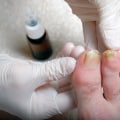 Is toenail fungus related to diet?