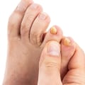 What is the most effective toenail fungus treatment?