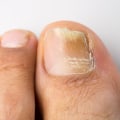Does vicks really work on toenail fungus?