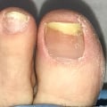 What kills toenail fungus?