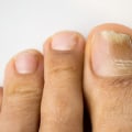 Stop Toenail Fungus from Spreading: How to Take Control