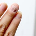 Do Over-the-Counter Toenail Fungus Medications Work?