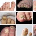 Is Your Toenail Fungus Treatment Working? Here's How to Find Out