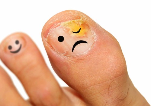 What is the danger of not treating toenail fungus?