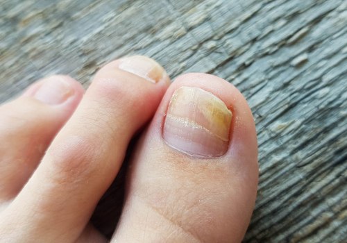 Is Toenail Fungus Treatment Working? Here's How to Know