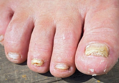 What are the most common treatments for toenail fungus?