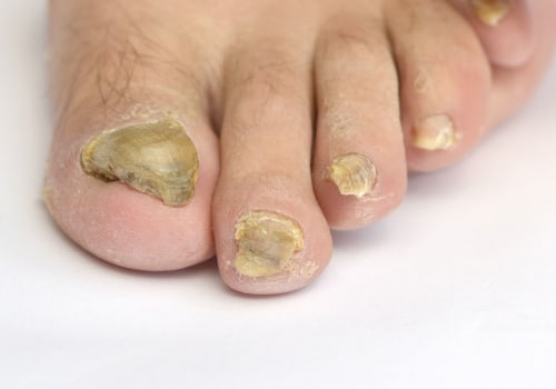 What is the strongest fungal nail treatment?