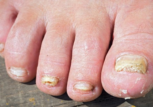Is it Safe to Wear Sandals While Treating Toenail Fungus?