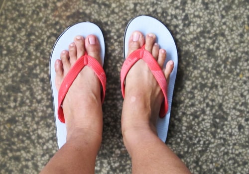 Does wearing sandals help with nail fungus?