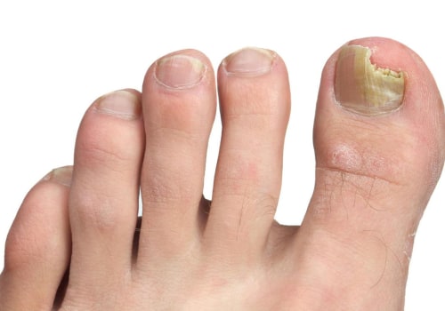 When should you see a dr for toenail fungus?
