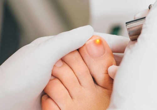 Is it Safe to Wear Socks While Treating Toenail Fungus?