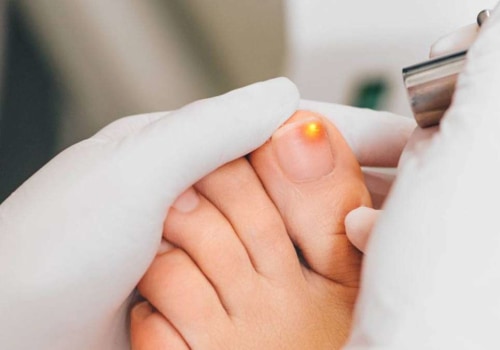 How to Get Rid of Toenail Fungus: A Comprehensive Guide