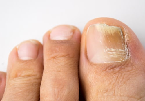 Does vicks really work on toenail fungus?