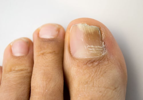 Stop Toenail Fungus from Spreading: How to Take Control
