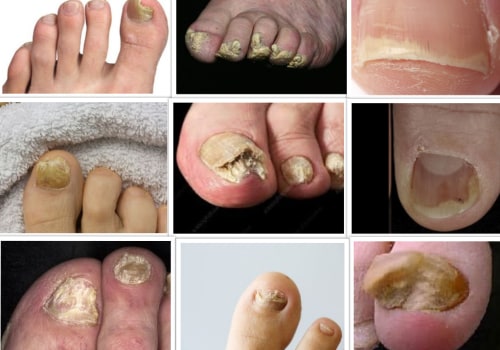 What makes toenail fungus worse?
