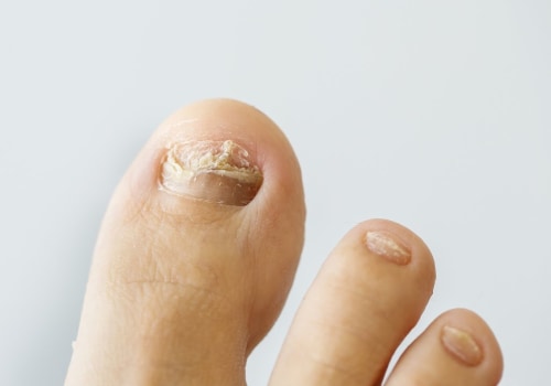 How to Keep Toenail Fungus from Coming Back