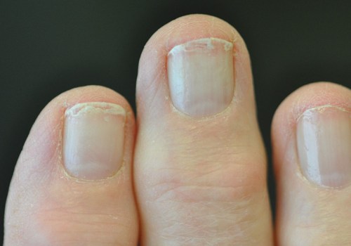 What are 3 signs of a fungal nail infection?