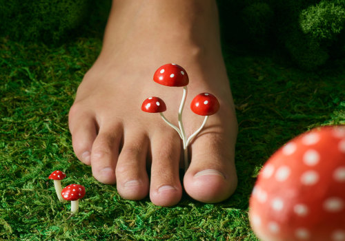 Can you get rid of toenail fungus permanently?